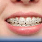 Invisible Braces: How to Clean & Maintain Clear Aligners